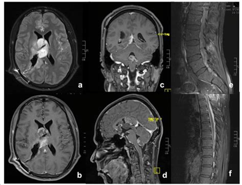 Left ventricular Mass, Brain MRI and Cognitive Performance: 